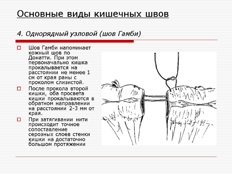 Основные виды кишечных швов  4. Однорядный узловой (шов Гамби) Шов Гамби напоминает кожный